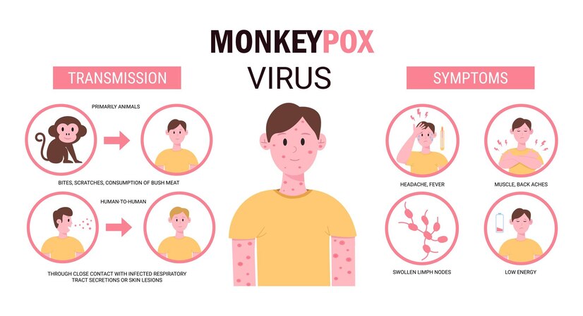 मंकीपॉक्स (Mpox) ची संपूर्ण माहिती: लक्षणे, प्रसार, आणि प्रतिबंध 3 Mpox (formerly known as monkeypox)