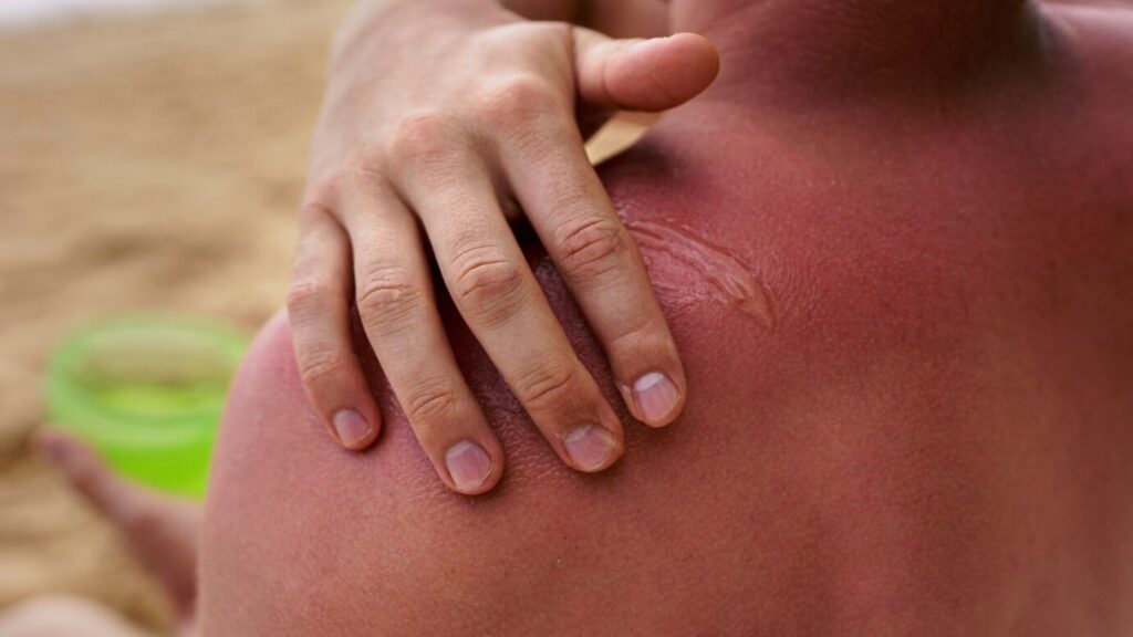 Summer Skin Care Tips: उन्हाळ्यात तापमानाचा भडका आणि त्वचेवर सनबर्न मुळे होणारे गंभीर परिणाम, जाणून घ्या. 3 Summer Skin Care Tips